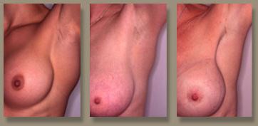 Transaxillary breast augmentation photo